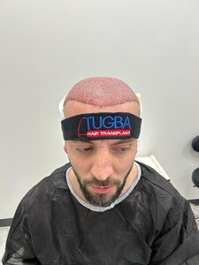 Tuğba Hair Transplant _1