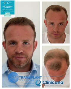 Hair Transplant Solutions _1
